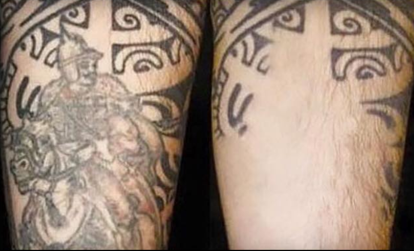 Readers' Choice Award for Best Laser Tattoo Removal